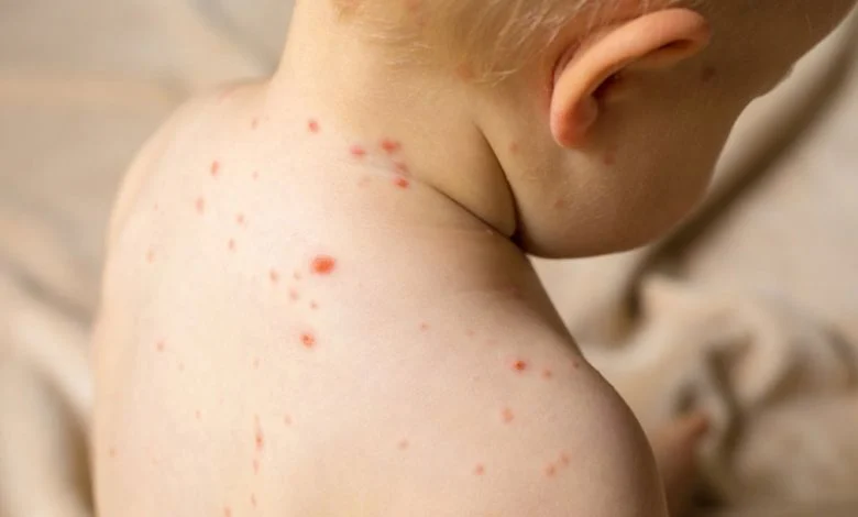 اجرای طرح واکسیناسیون تکمیلی سرخک، سرخجه و اوریون کودکان ۹ ماه تا ۷ ساله شهرستان بندرلنگه