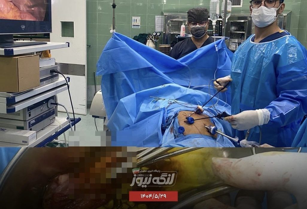 خروج ۱۰۰ سنگ صفرا از یک بیمار در پارسیان