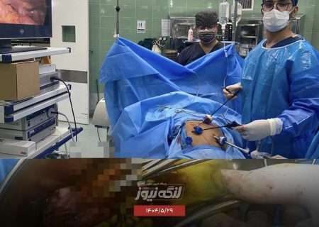 خروج ۱۰۰ سنگ صفرا از یک بیمار در پارسیان